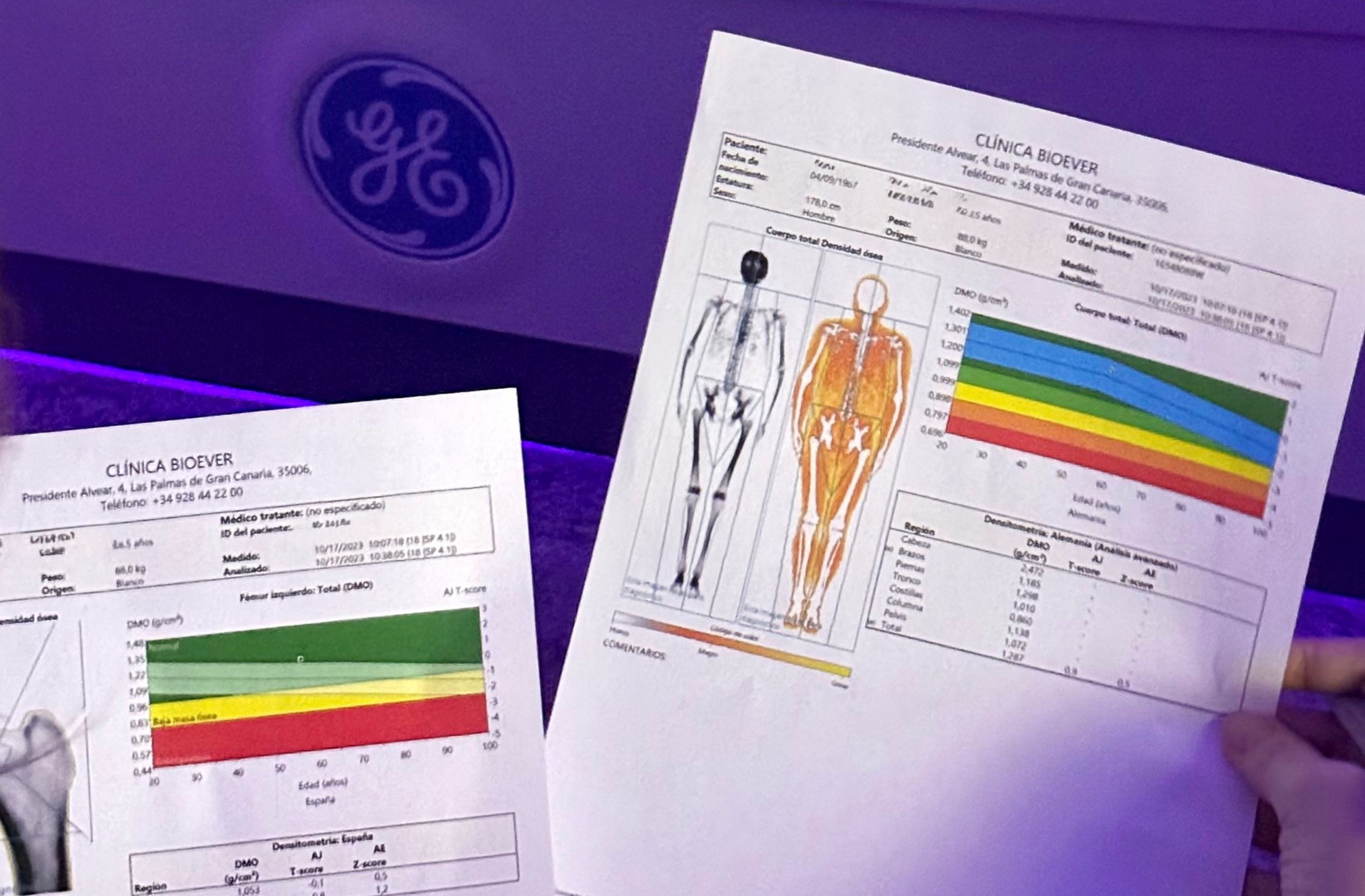Estudio de composición corporal DEXA y los datos que revela
